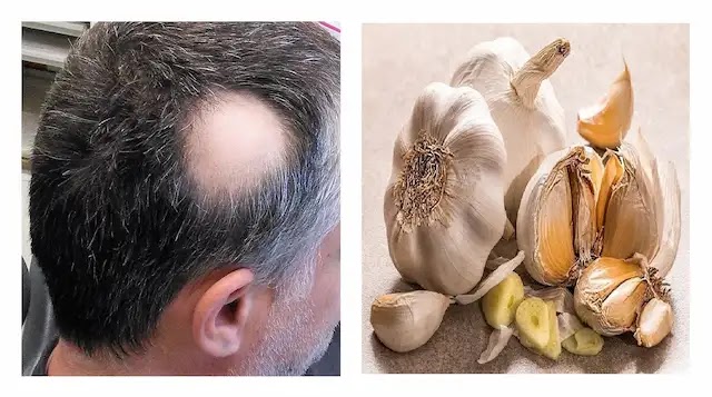 الثعلبة وطرق طبيعية للوقاية منها