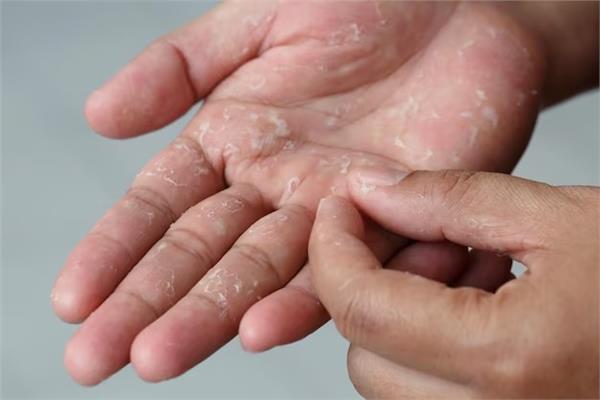 تعرق اليدين و تأثيره على الحياة اليومية وطرق العلاج
