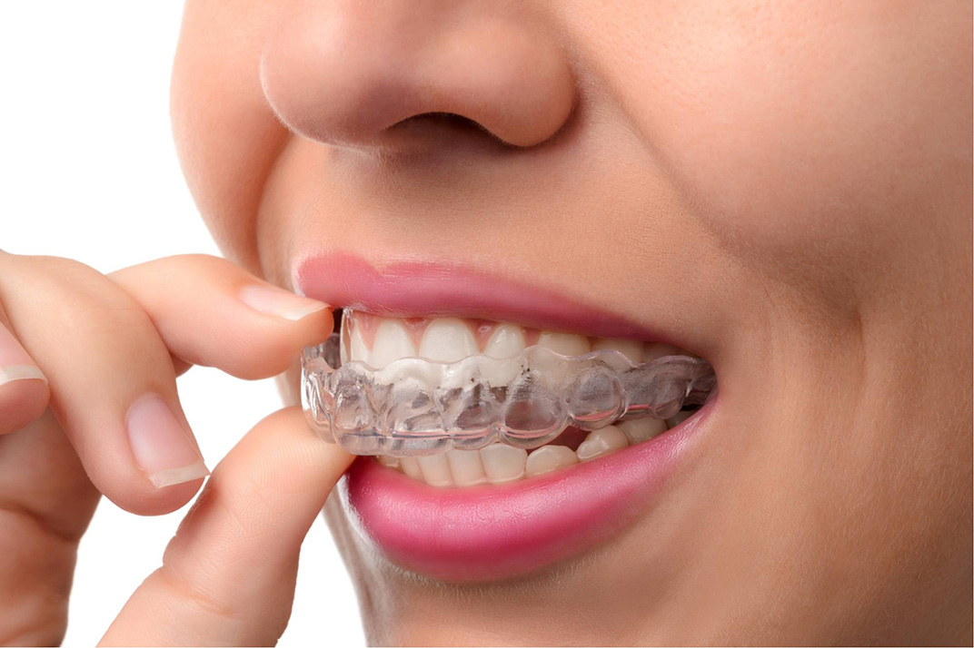 مثبت الأسنان بعد التقويم وأنواعه