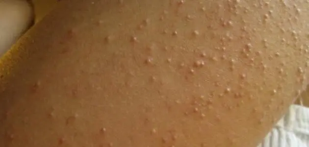 أعراض الطفح الجلدى وطرق الوقايه منه