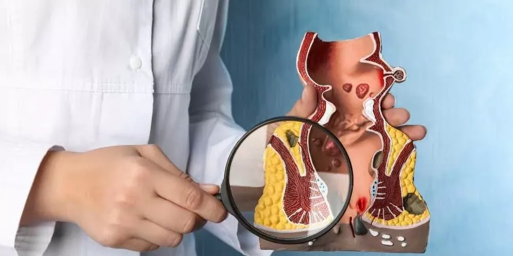 أحدث التقنيات الجراحية لعلاج البواسير