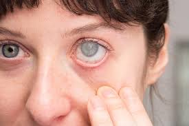 ارتشاح العين وأبرز أعراضه