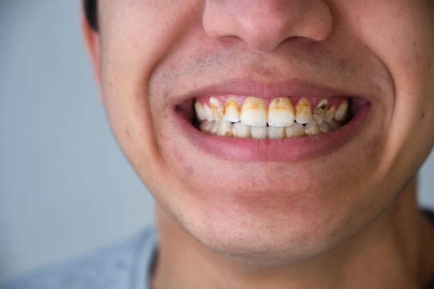 هل تزيد القهوة من خطر تسوس الأسنان ؟