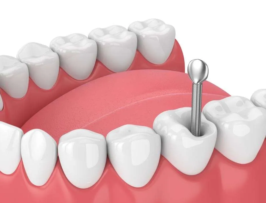 دعامات الأسنان وأنواعها