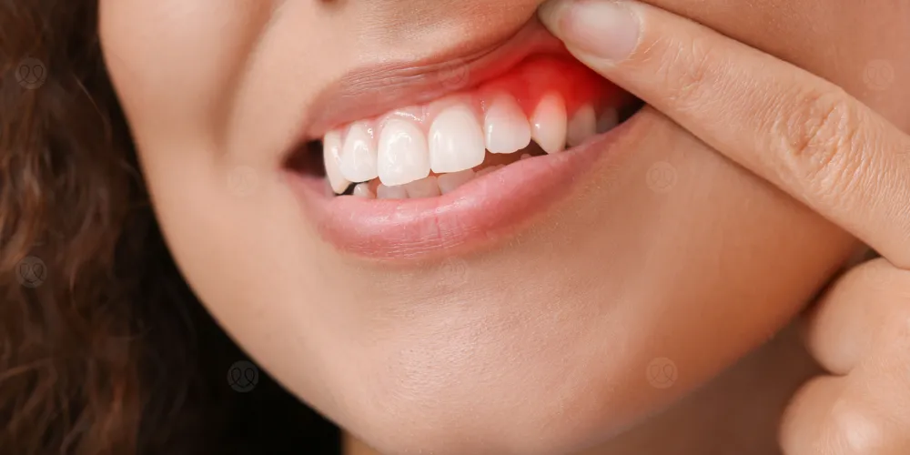 أسباب التهاب ضرس العقل