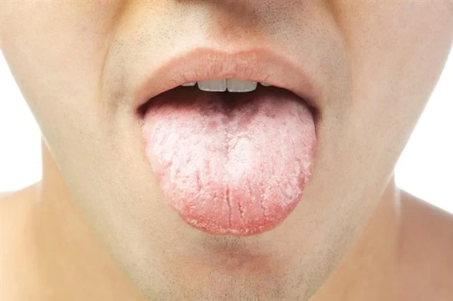 تسوس الأسنان الأمامية وأهم أسبابها