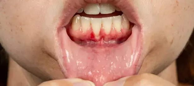 أمراض اللثة الخطيرة وأعراضها