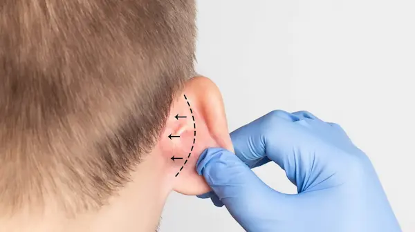 عملية تجميل الأذن وكل ماتحتاج معرفته عنها
