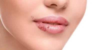 تكتل الفيلر ومخاطر فيلر الشفايف
