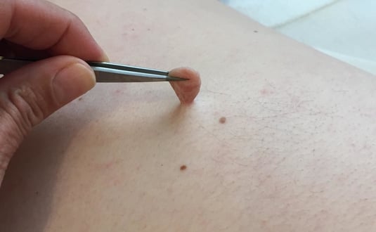 السنط في الجلد وطرق الوقاية منه