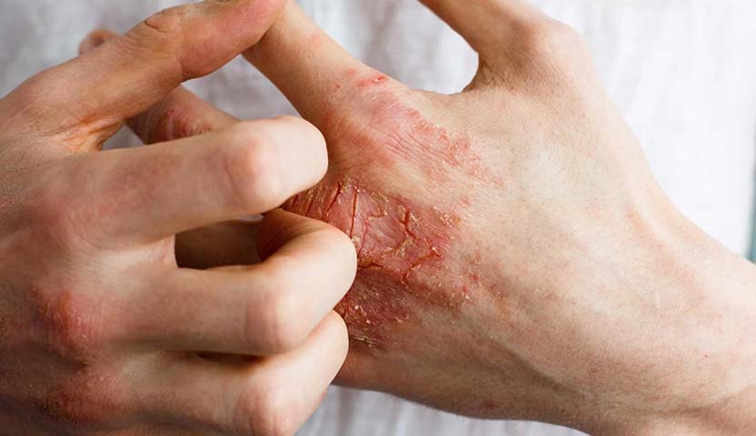 الهربس النطاقي ومضاعفاته