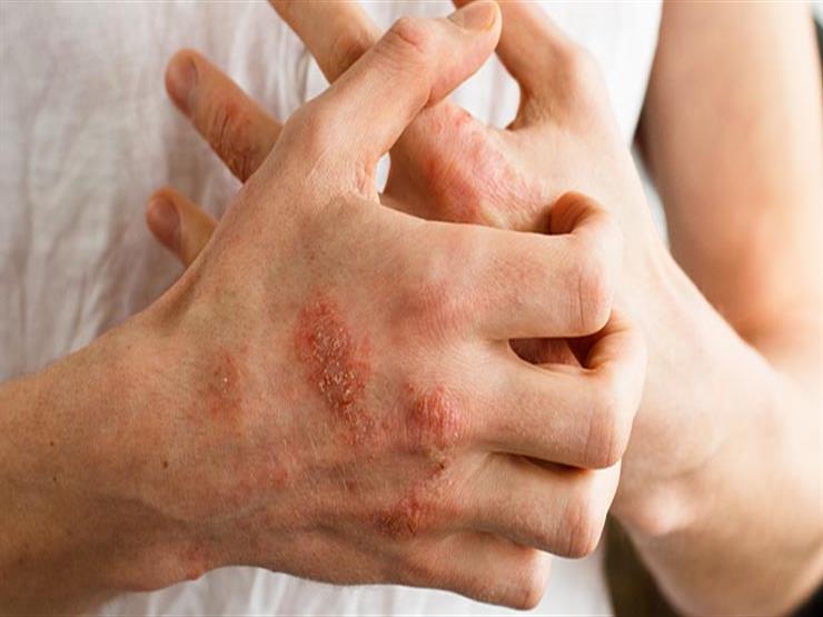 جدري الماء والحزام الناري والفرق بينهم