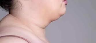 ماهي متلازمة كوشينغ وأعراضها ؟