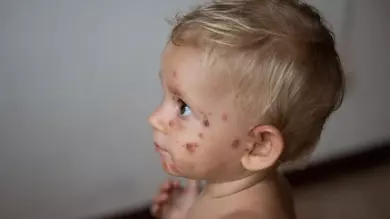 مرض الحصف وأسباب ظهوره