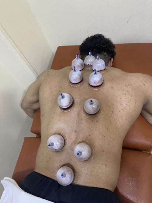 عرض علي جلسات الحجامه العلاجيه