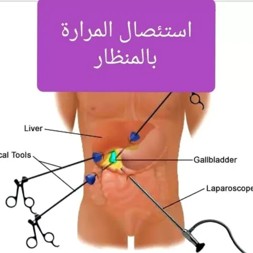 استئصال المرارة بالمنظار