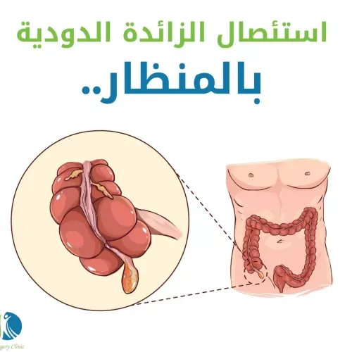 استئصال الزائدة الدودية بالمنظار