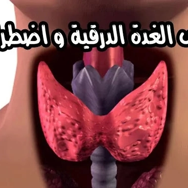 استئصال الغدة الدرقية