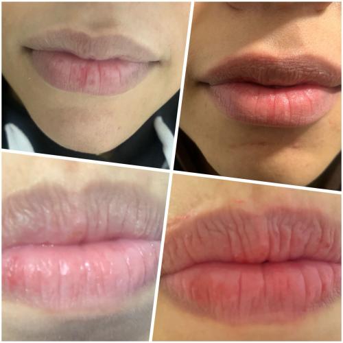 Dermapen Session for mesotherapy and lip pinkening
