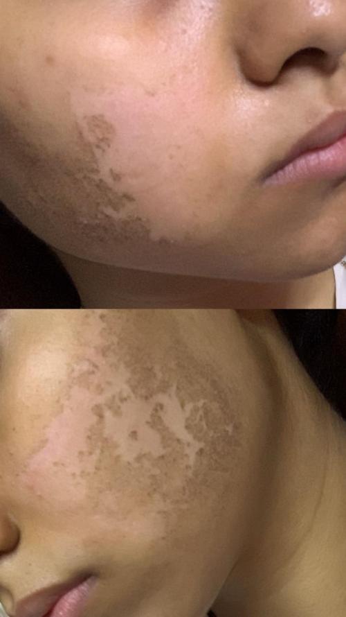 Peeling and Pinkening Session for Prevention