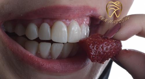 Your Smile. Designed First. 10% Off Digital Smile Design & Veneers