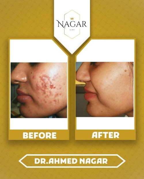 تقشير احماض الفواكه للبشرة