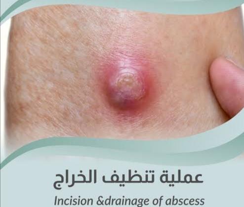 فتح خراج تحت مخدر موضعى
