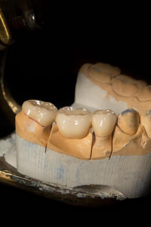 تركيب طربوش بورسلين