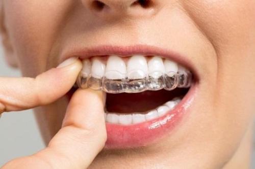 تقويم الاسنان الشفاف