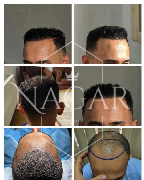 زراعة الشعر بالنانو FUE