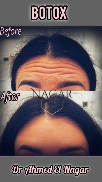 جلسة البوتوكس للوجه بالكامل (Full Face Botox)