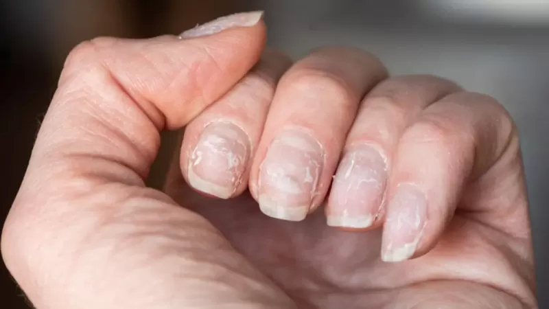 نصائح للوقاية من فطريات الأظافر والحفاظ على صحتها