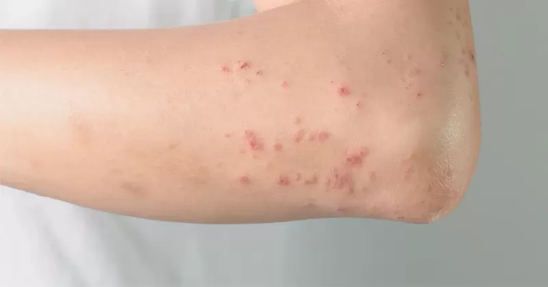 أسباب وأعراض الطفح الحراري ونصائح للتعامل معها