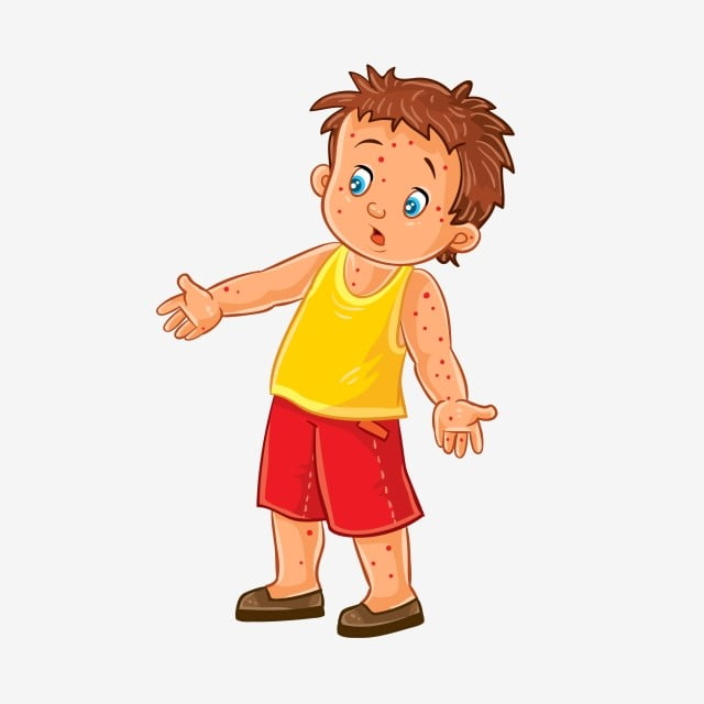 مرض الجدرى اسبابه وعوامله وخطر الاصابة به