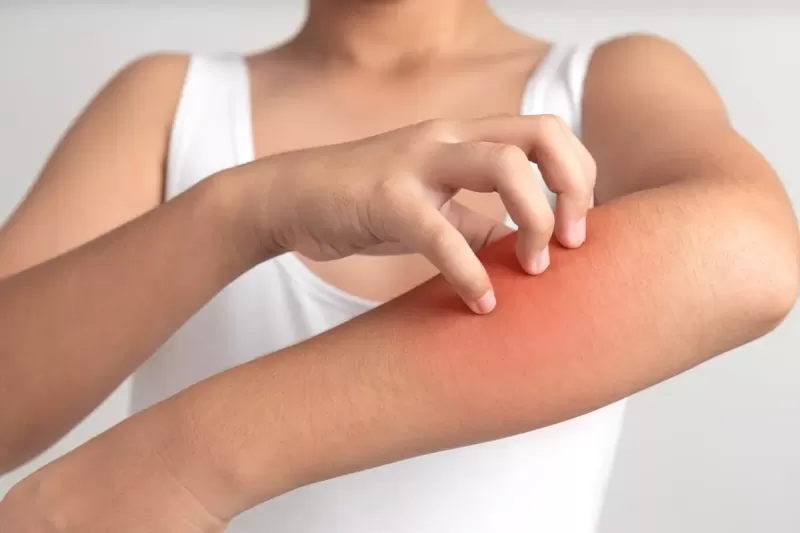 الامراض الجلدية فى فصل الصيف وعلاج حساسية الجلد من الحرارة