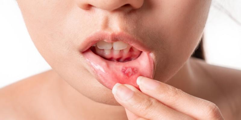 مرض أبو حافور عند الأطفال  وأعراضه