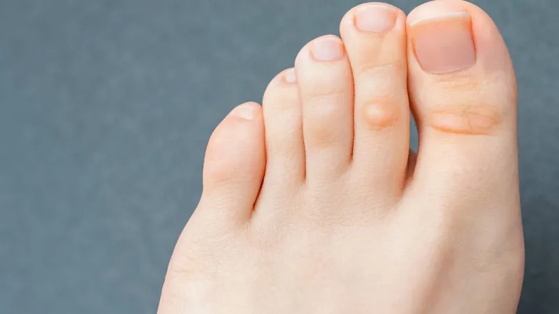 مسمار القدم  وعوامل خطر الإصابة به