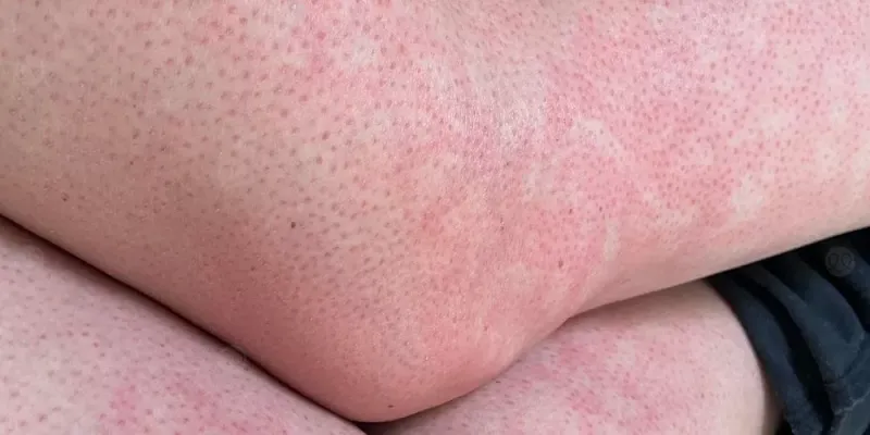مرض التزرق الشبكي  وطرق الوقاية منه