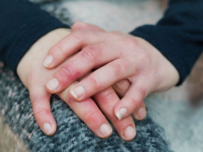 مرض رينود وأسبابه وعوامل خطورته