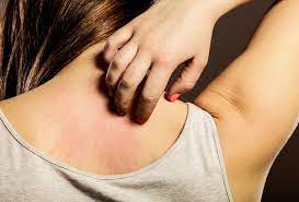 الحزام الناري  وأعراضه