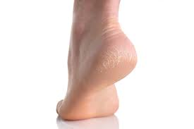 تشقق القدمين  وطرق الوقاية منه