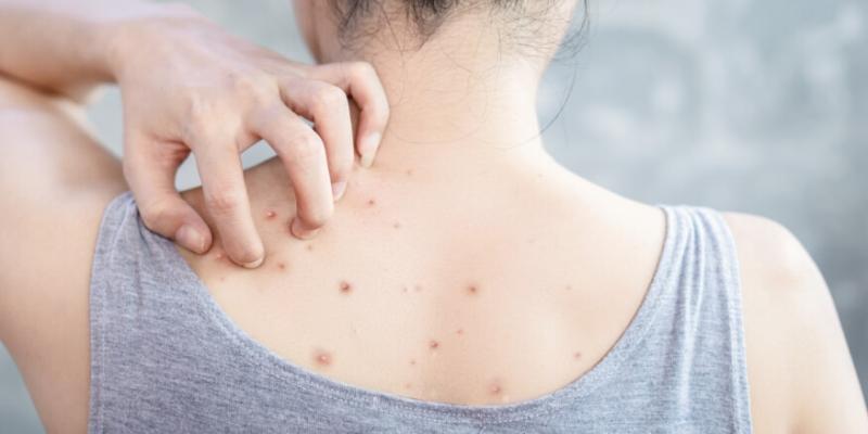 حبوب الظهر وأسبابها وطرق الوقاية منها