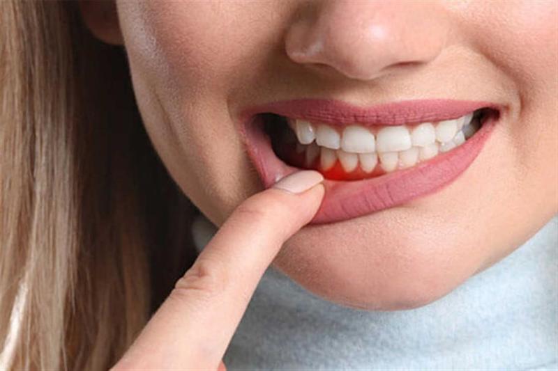 التهاب اللثة ونصائح بسيطة للحد منها فى المنزل