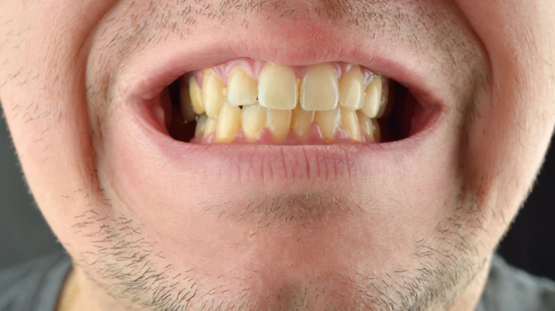 اصفرار الأسنان وأسبابه وطرق الوقايه منه