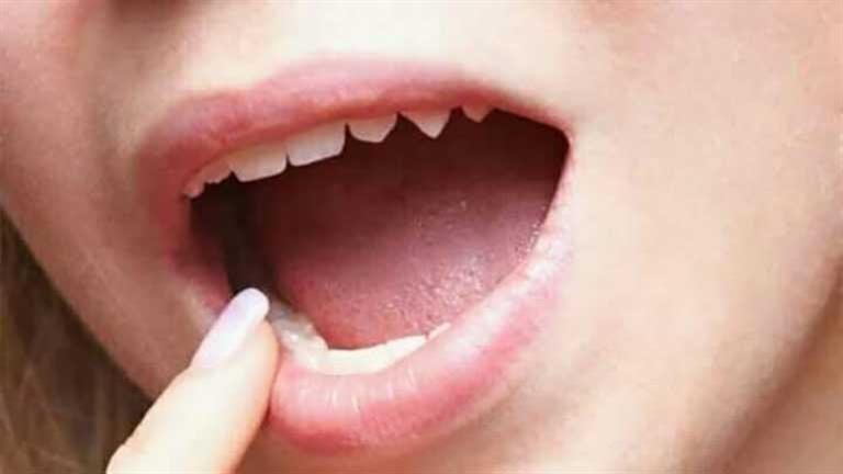 العلاقة بين ارتجاع المريء وصحة الفم والأسنان