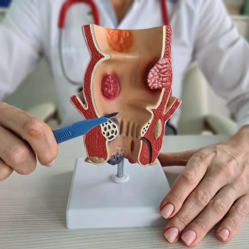 أحدث التقنيات الجراحية لعلاج البواسير