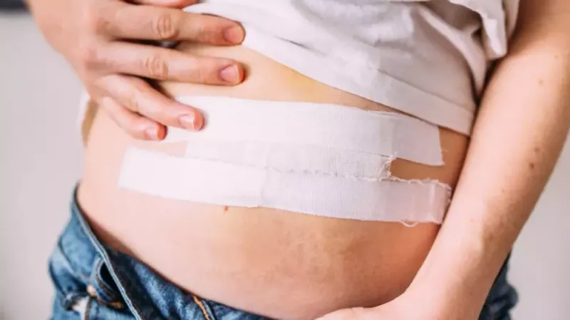 أنواع عمليات الفتق