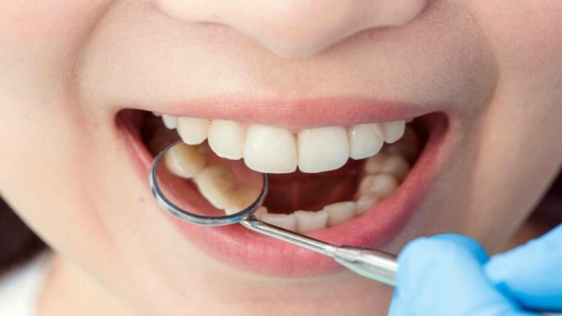 تسوس الأسنان وأهم أسبابه