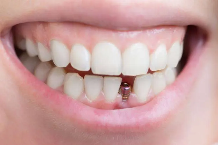 نصائح هامة بعد زراعة الأسنان