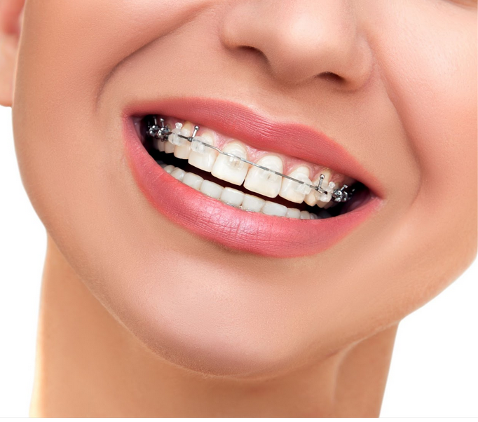 تقويم الأسنان وأهم أنواعه